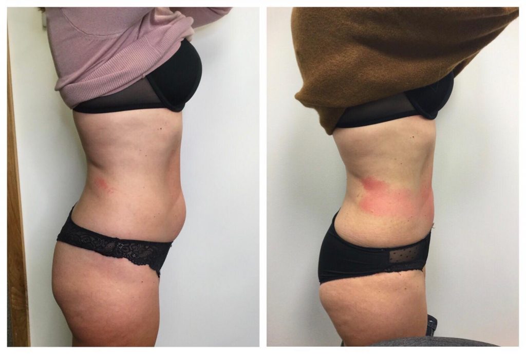 Skin contouring, toning and tightening with the LP tummy tuck and Butt Lift  - a client testimonial - The AL5 Aesthetics
